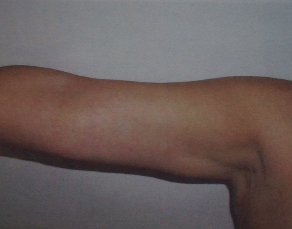 Before and after Arm Lift Brachioplasty long(2