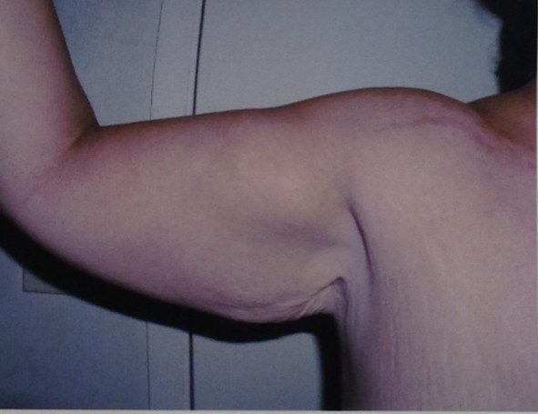 Before and after Arm Lift Brachioplasty