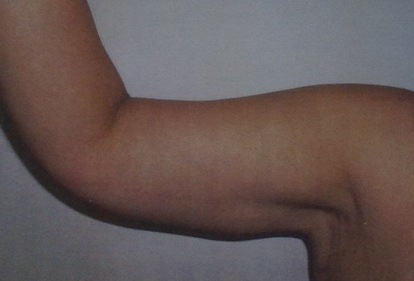 Before and after Arm Lift Brachioplasty(1)