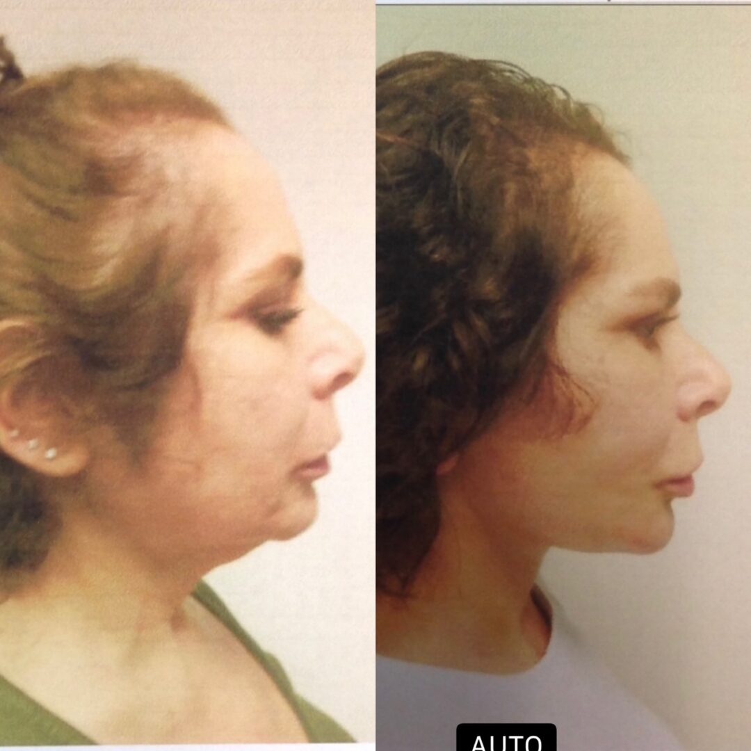 Facelift before and after