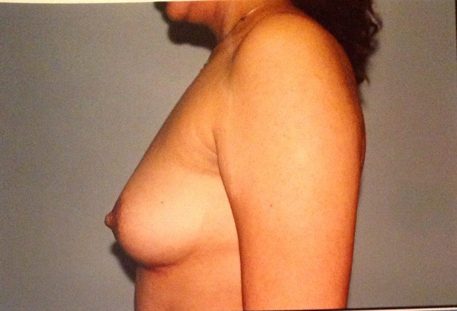Before and after breast implant augmentation1