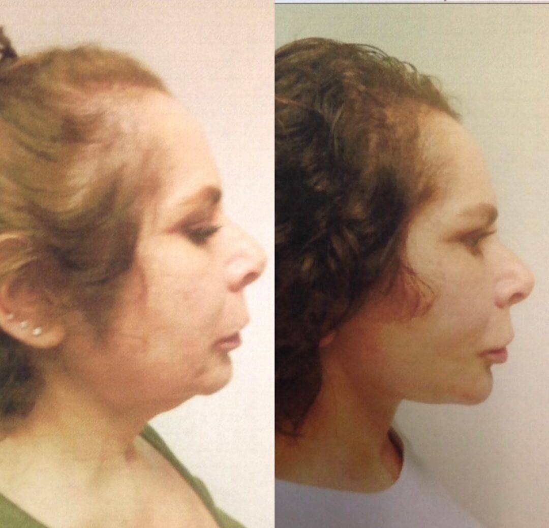 Before-and-after-Facelift