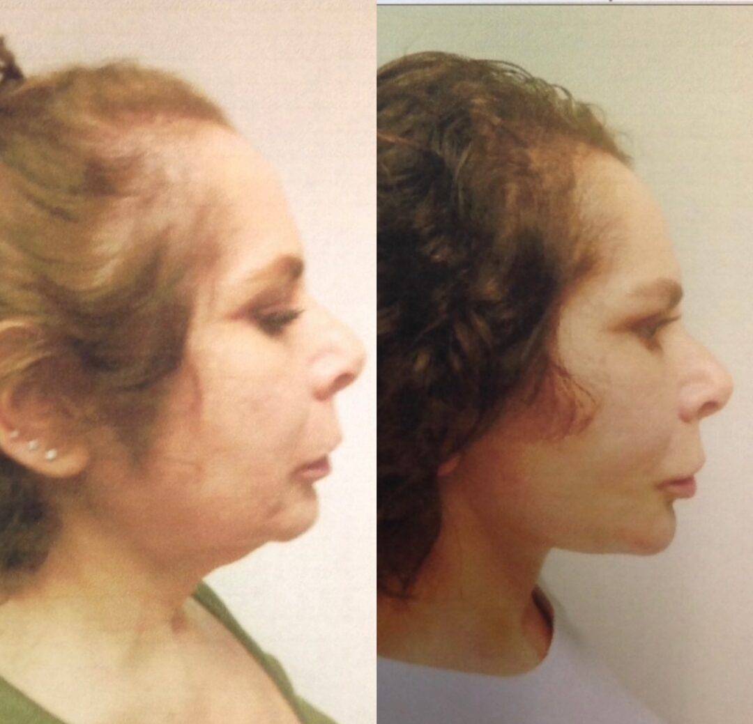 A woman's face before and after liposuction.