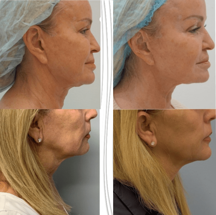 A woman's face before and after liposuction.