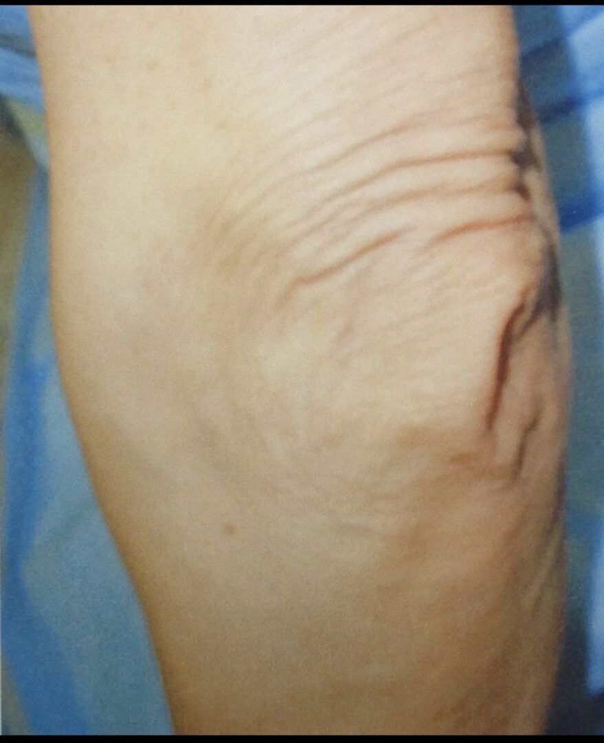 Before elbow lift procedure image of a patient image on a blue background
