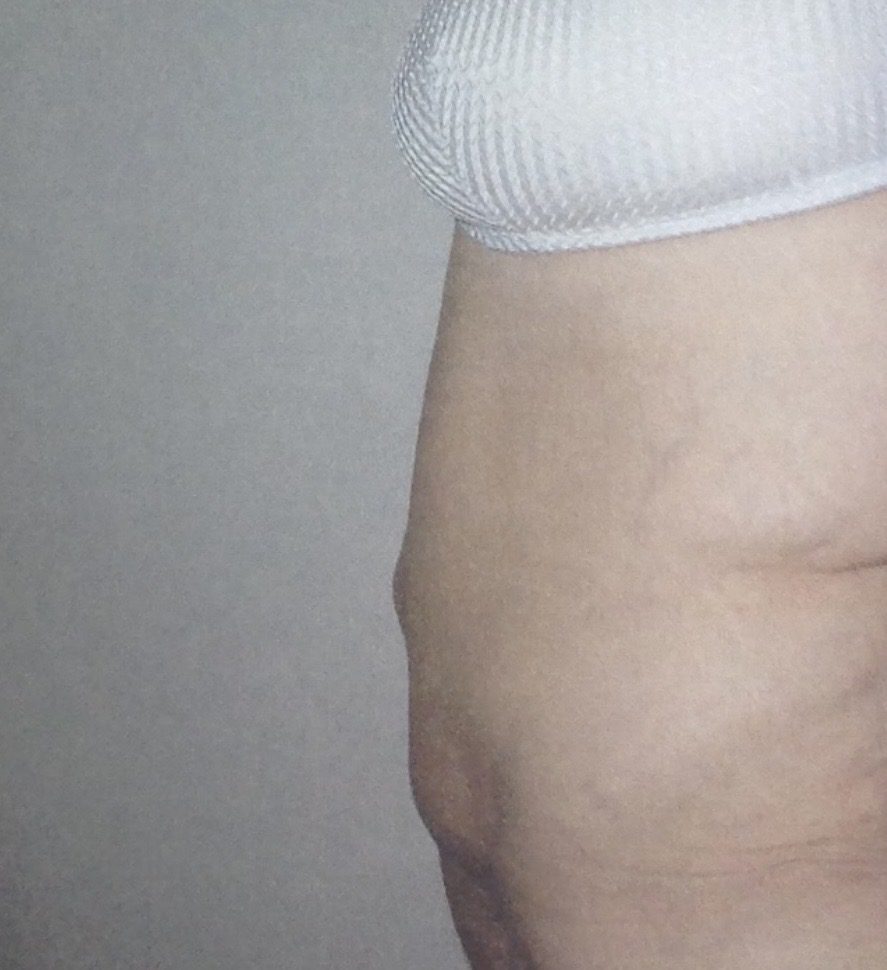 After photo of abdominoplasty with Fleur-de-Lys technique for post-weight-loss body contouring by Dr. Michelle Zweifler