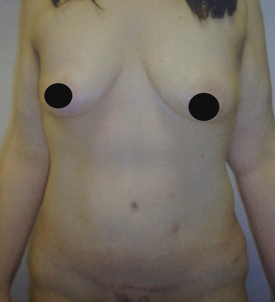 After photo of abdominoplasty (tummy tuck) for post-weight-loss body contouring by Dr. Michelle Zweifler