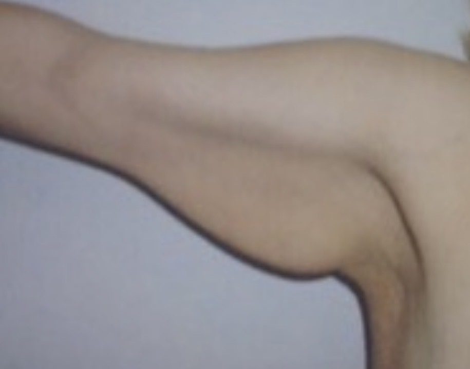 Before photo of arm lift (brachioplasty) for post-weight-loss body contouring by Dr. Michelle Zweifler