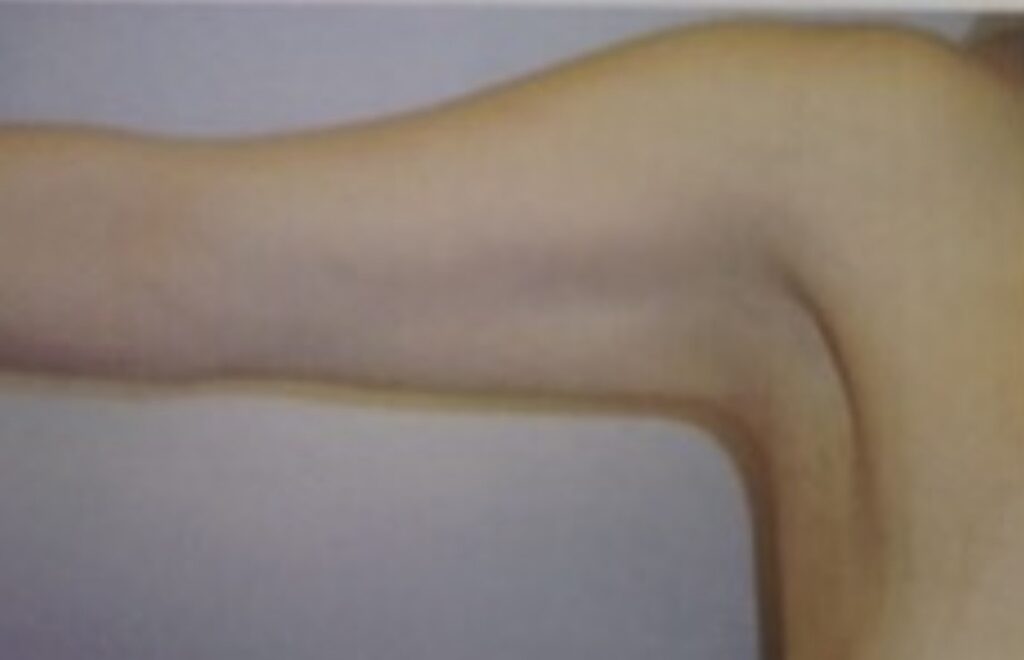 After photo of arm lift (brachioplasty) for post-weight-loss body contouring by Dr. Michelle Zweifler