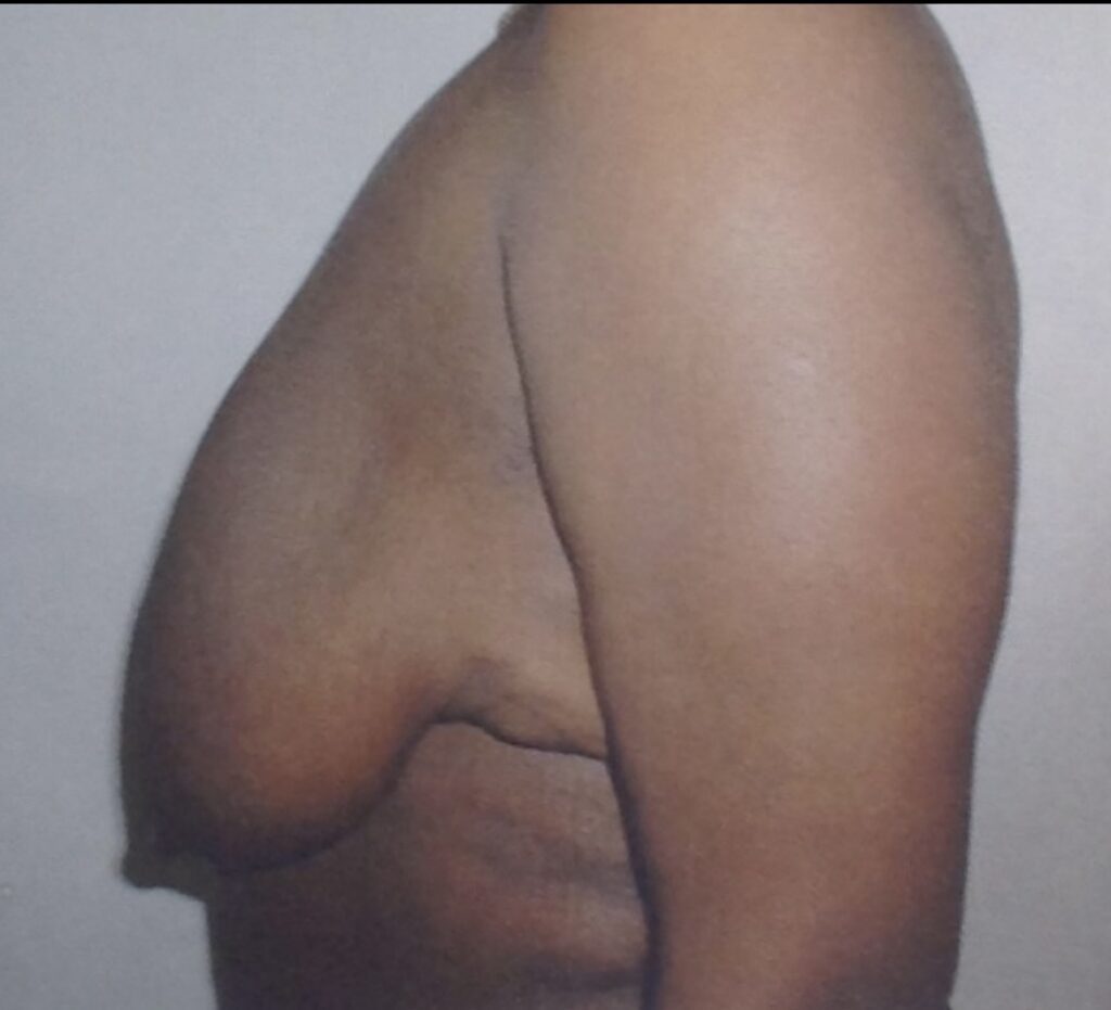 Before photo of breast lift with lateral chest wall excision for post-weight-loss body contouring by Dr. Michelle Zweifler
