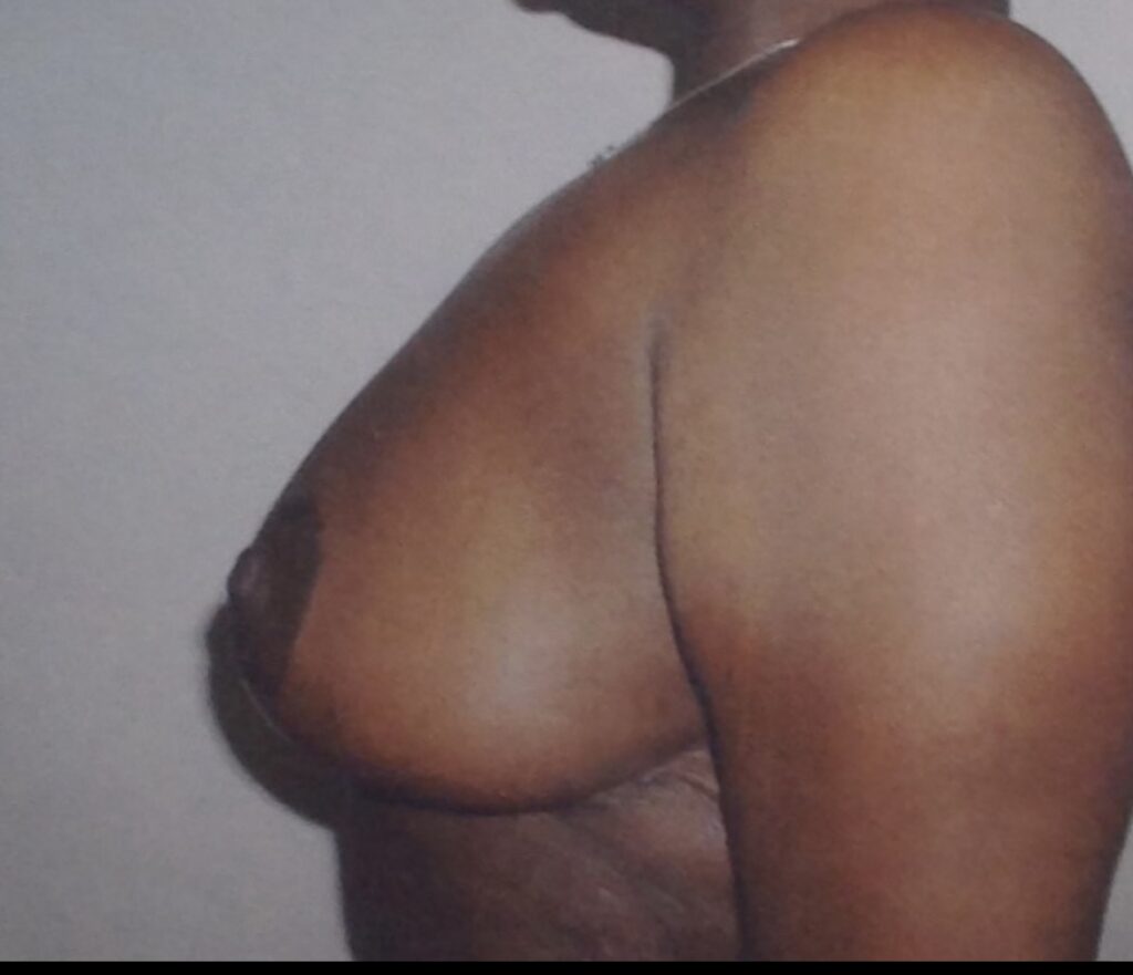 After photo of breast lift with lateral chest wall excision for post-weight-loss body contouring by Dr. Michelle Zweifler
