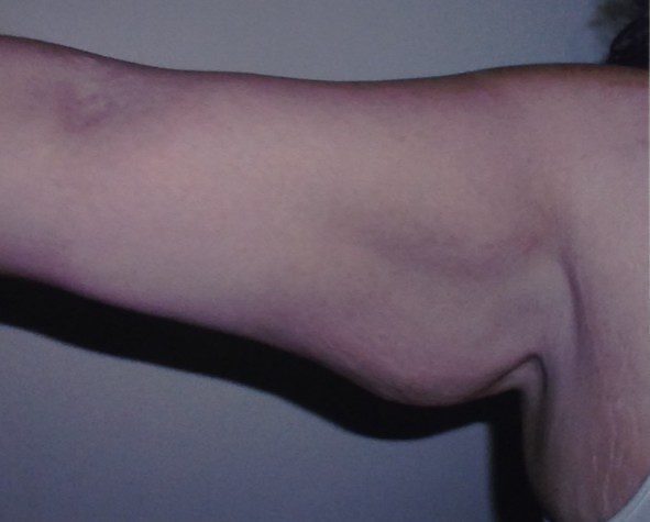 Arm lift after photo, patient 3, view 1