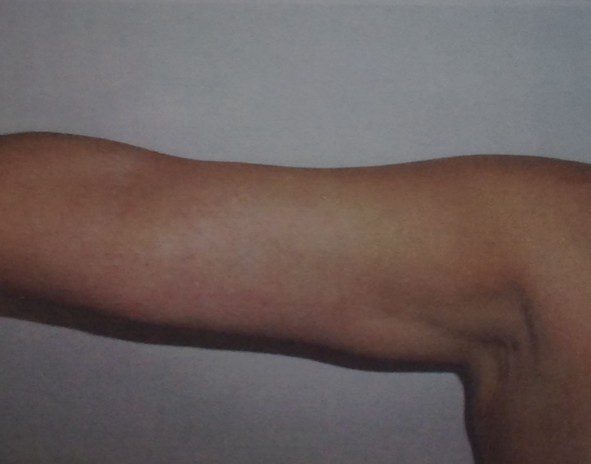 Arm lift after photo, patient 3, view 2
