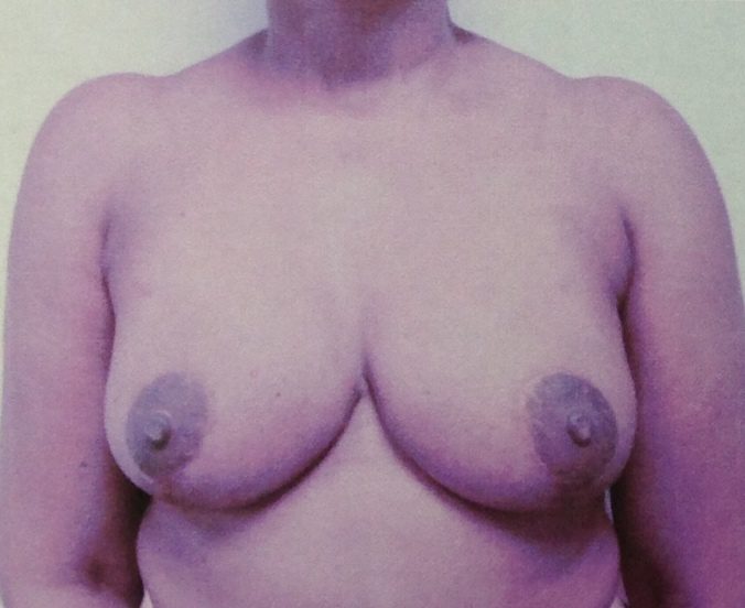 Breast lift after photo, patient 2