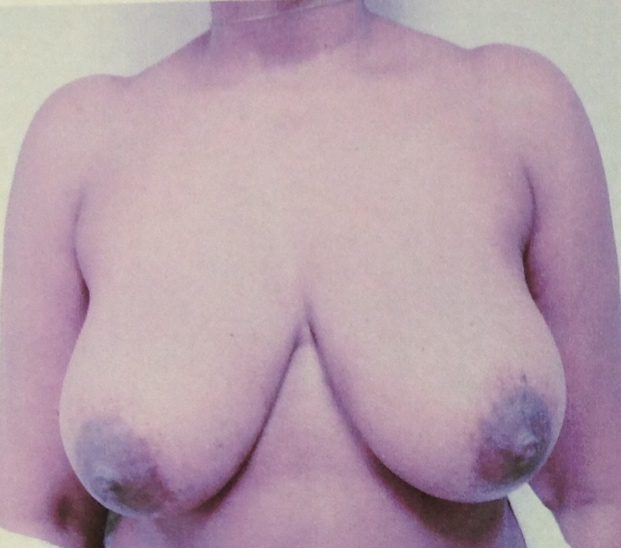 Breast lift before photo, patient 2