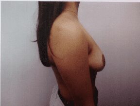 Breast reduction after photo, patient 2, revised crop