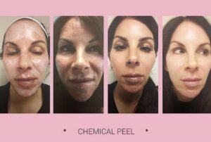 TCA chemical peel immediately after, 2 days, 1 week, and 3 months