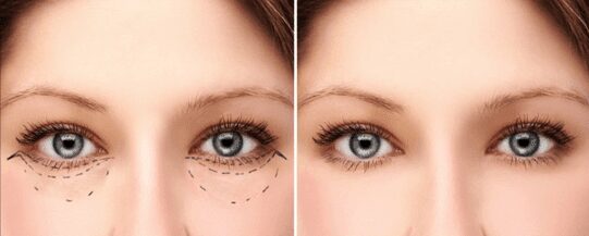 Lower eyelid surgery illustration