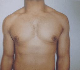 Gynecomastia after photo, patient 2, view 1
