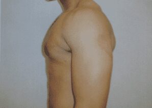 Gynecomastia after photo, patient 2, view 2