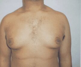 Gynecomastia before photo, patient 2, view 1