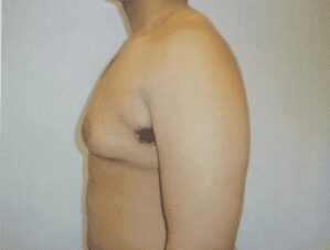 Gynecomastia before photo, patient 2, view 2