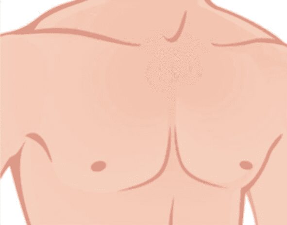 Gynecomastia illustration after