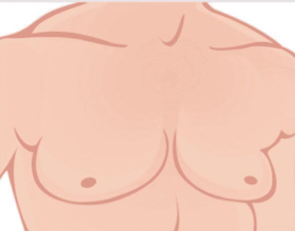 Gynecomastia illustration before
