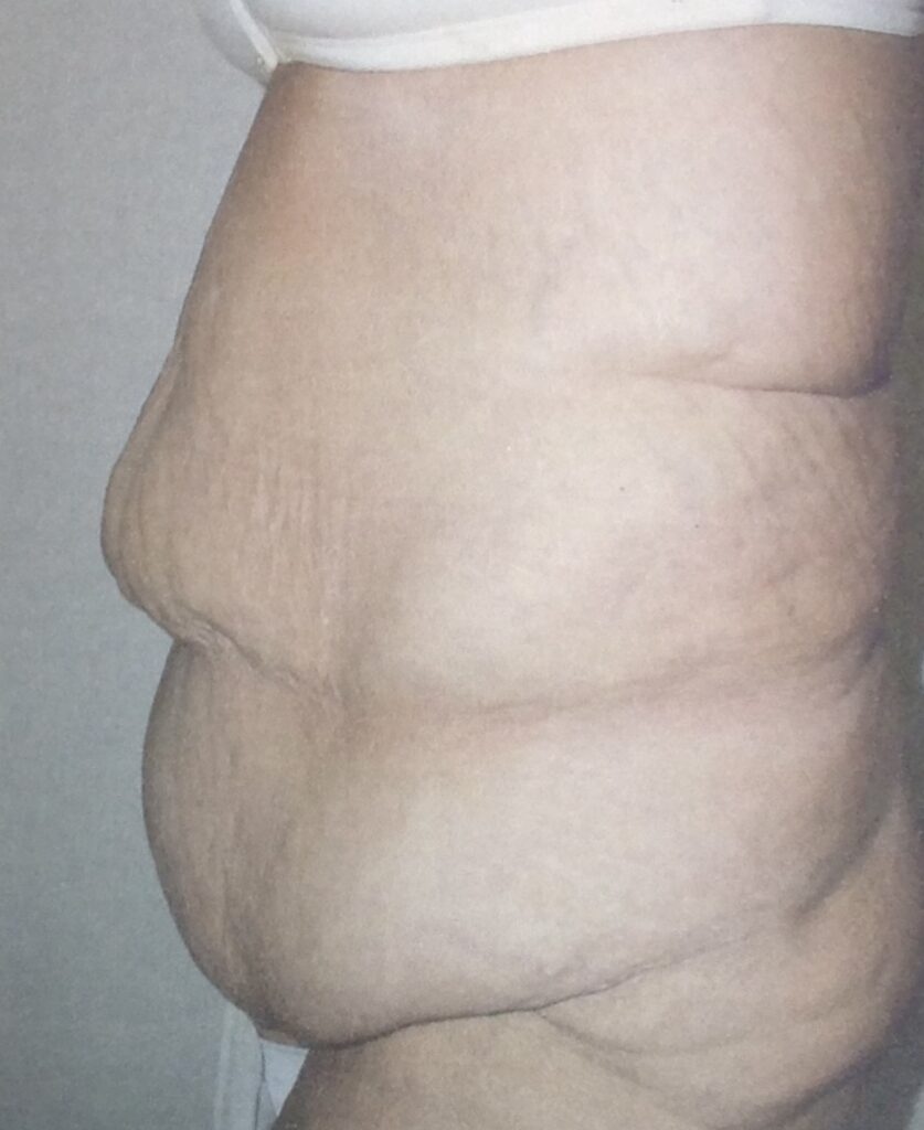 Before photo of abdominoplasty with Fleur-de-Lys technique for post-weight-loss body contouring by Dr. Michelle Zweifler