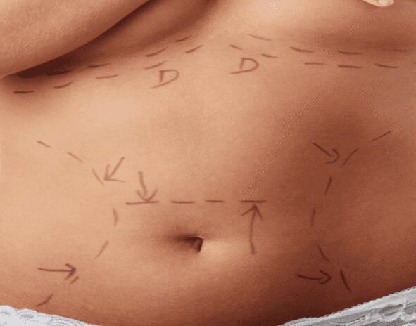 Liposuction illustration