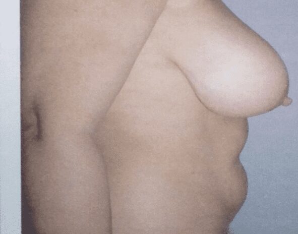 Mommy makeover before photo, breast reduction and abdominoplasty