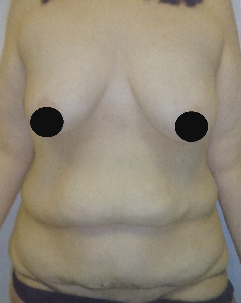 Before photo of abdominoplasty (tummy tuck) for post-weight-loss body contouring by Dr. Michelle Zweifler
