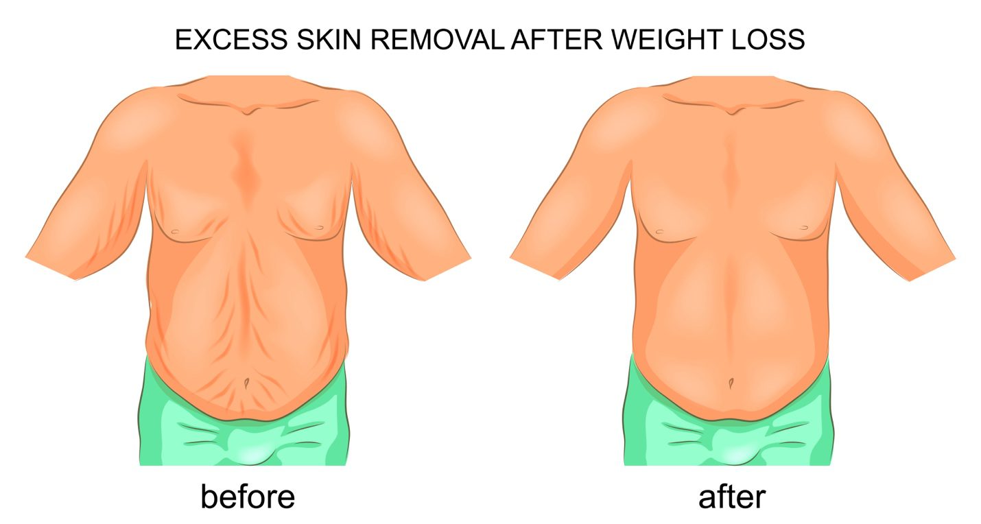 Post weight loss body contouring illustration