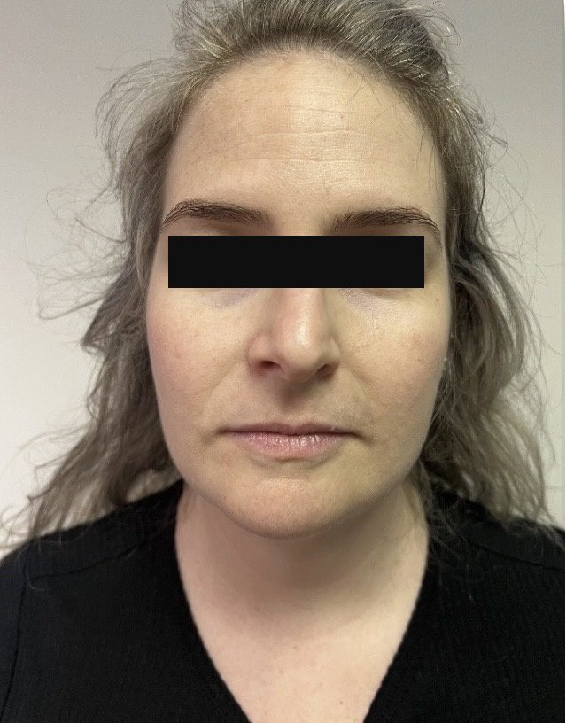 Before photo of Botox treatment for frown and forehead lines with Dr. Michelle Zweifler, patient's eyes covered for privacy