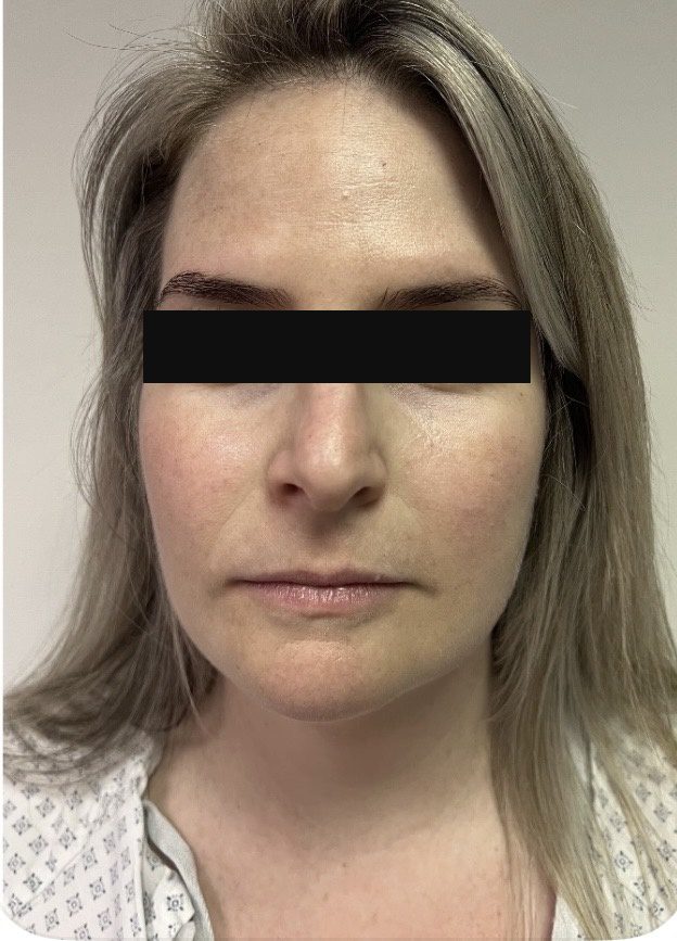 After photo of Botox treatment for frown and forehead lines with Dr. Michelle Zweifler, patient's eyes covered for privacy