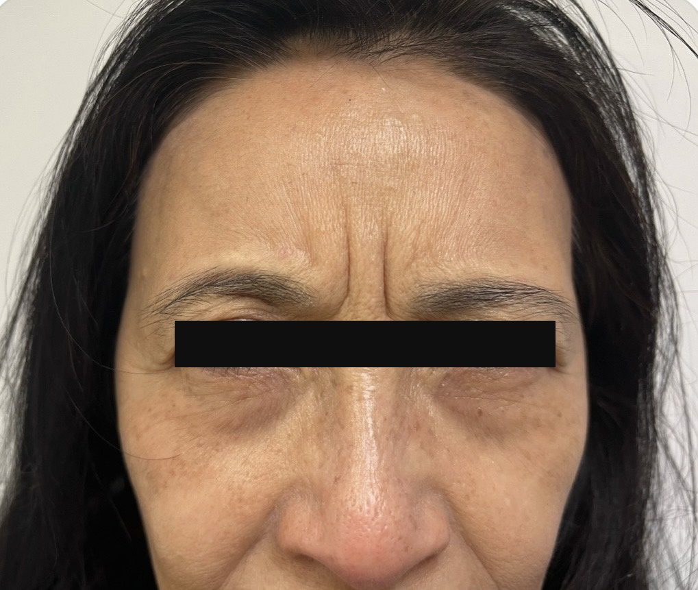 Before photo of Botox treatment for frown lines between the brows with Dr. Michelle Zweifler, patient's eyes covered for privacy