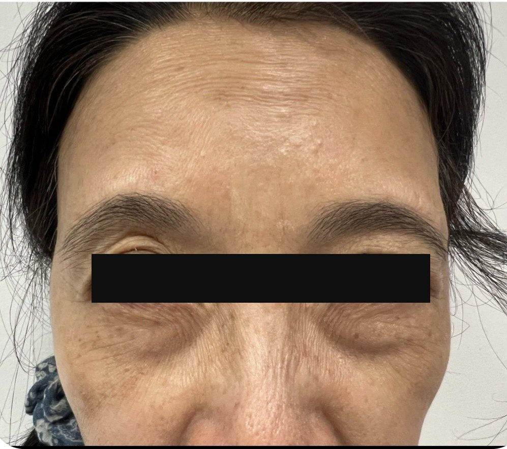 After photo of Botox treatment for frown lines between the brows with Dr. Michelle Zweifler, patient's eyes covered for privacy