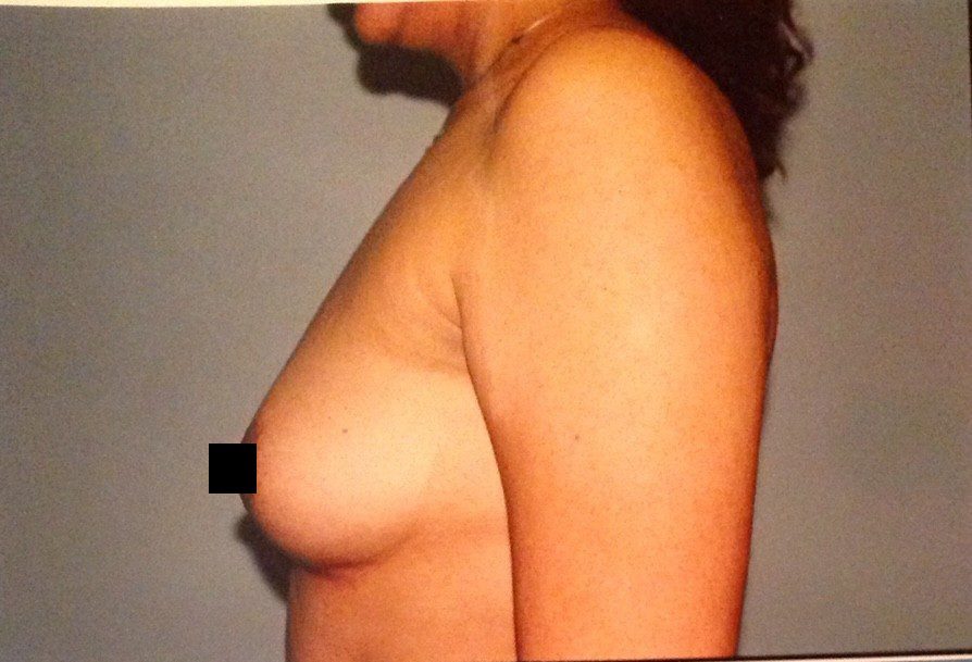Breast augmentation before, side view