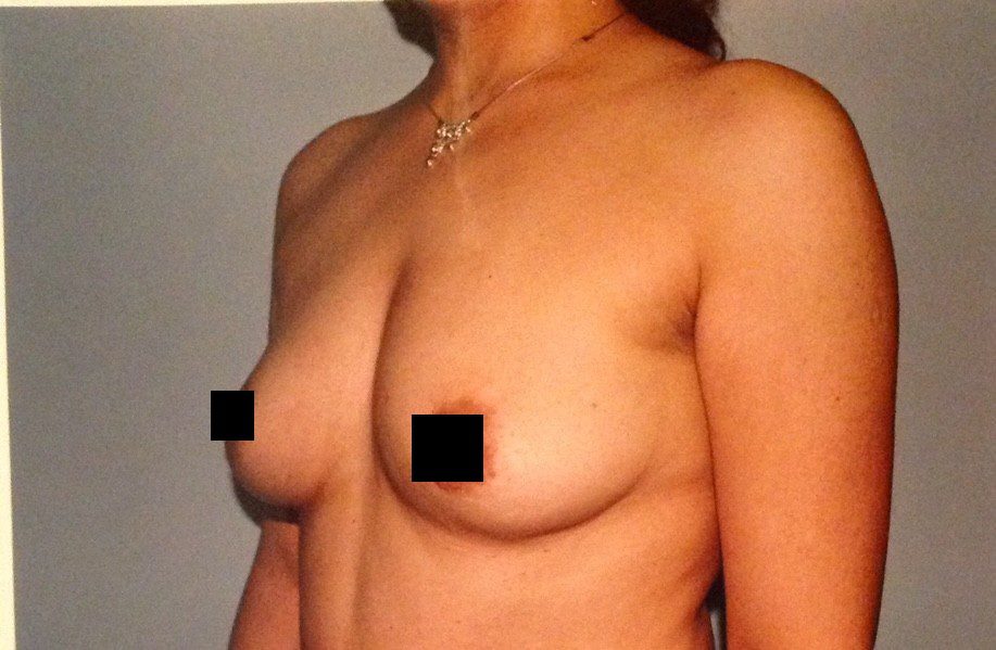 Breast augmentation before, three-quarter view