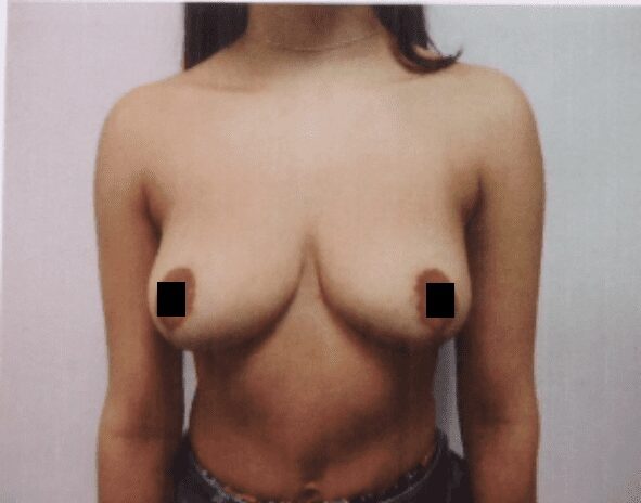 Breast reduction after photo, front view