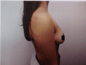 Breast reduction after photo, side view