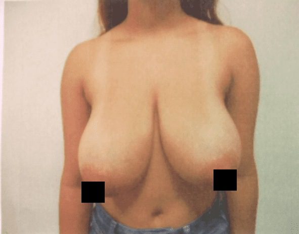 Breast reduction before photo, front view