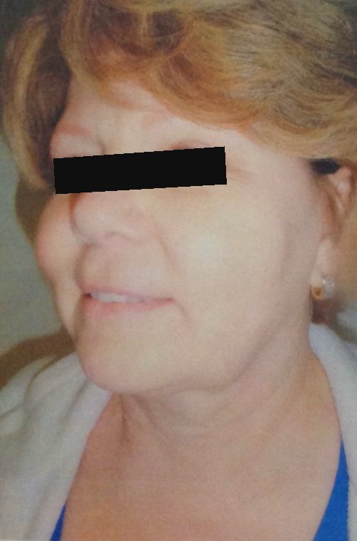 After facial fat grafting – patient 1 with Dr. Michelle Zweifler (eyes covered for privacy)