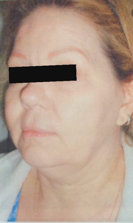 Before facial fat grafting – patient 1 with Dr. Michelle Zweifler (eyes covered for privacy)