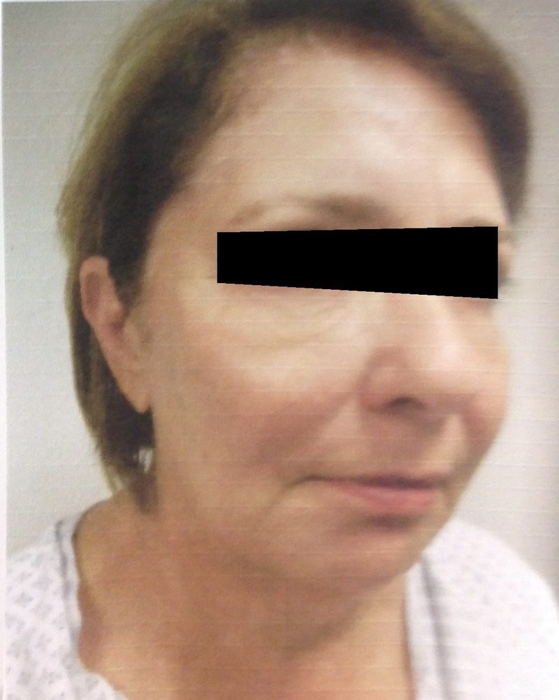 After facial fat grafting – patient 2 with Dr. Michelle Zweifler (eyes covered for privacy)