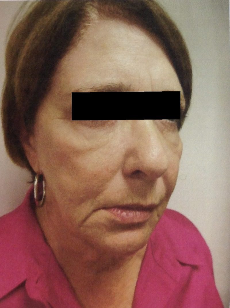 Before facial fat grafting – patient 2 with Dr. Michelle Zweifler (eyes covered for privacy)