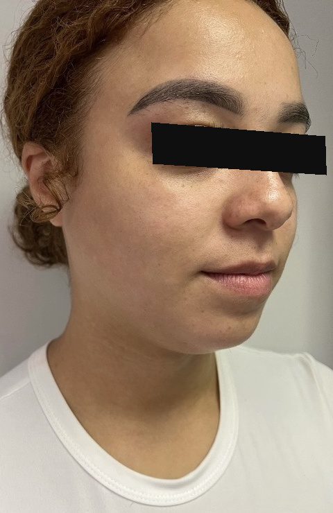 Before photo of Kybella treatment for double chin (submental fullness) with Dr. Michelle Zweifler, patient's eyes covered for privacy