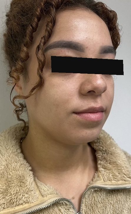 After photo of one Kybella treatment for double chin (submental fullness) with Dr. Michelle Zweifler, patient's eyes covered for privacy