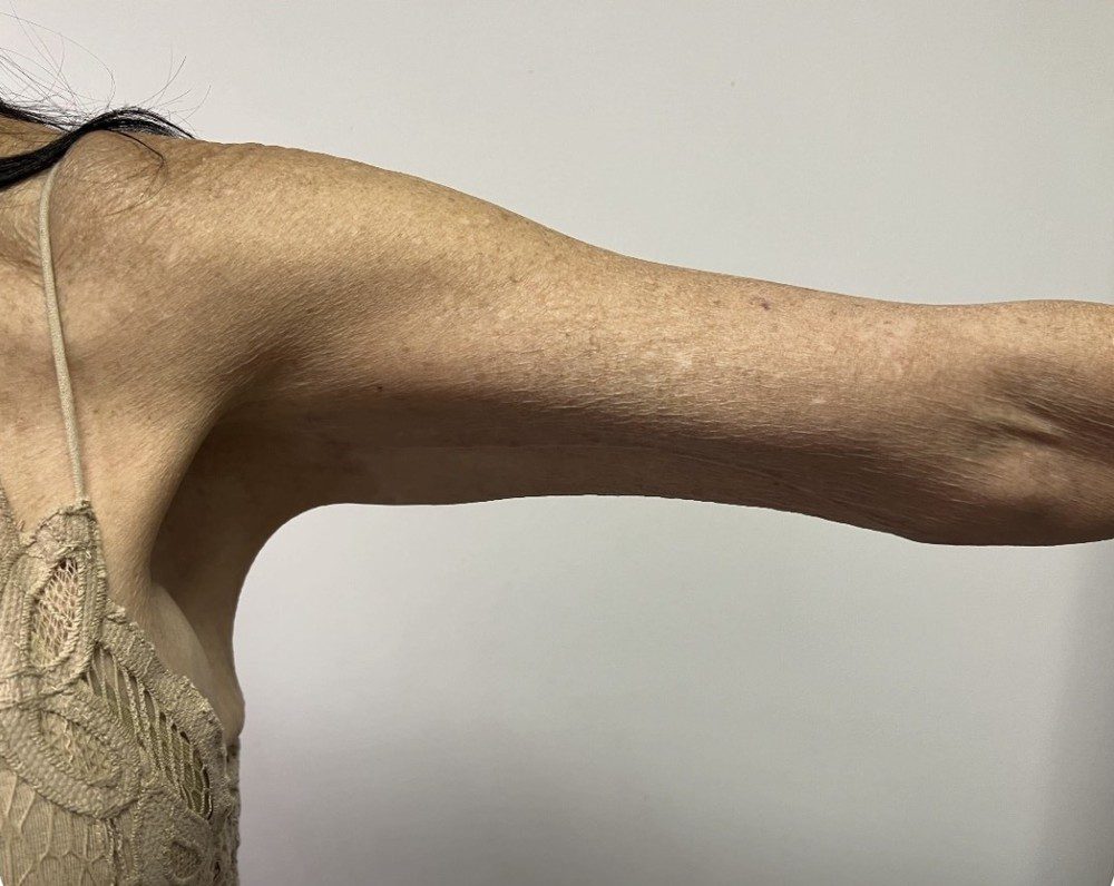 After arm lift with Dr. Michelle Zweifler
