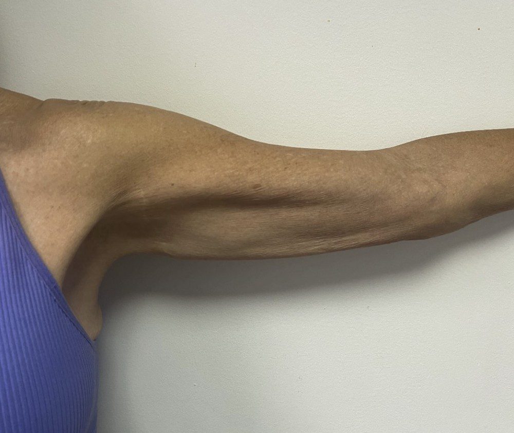Before arm lift with Dr. Michelle Zweifler